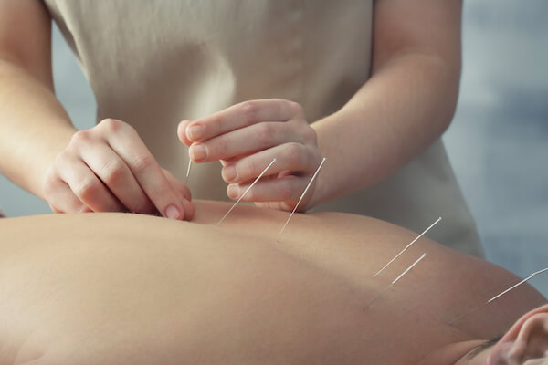 Acupuncture For Post-stroke Rehabilitation | Oriental Remedies