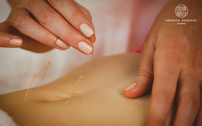 : TCM treatments for menstrual cramps-acupuncture singapore