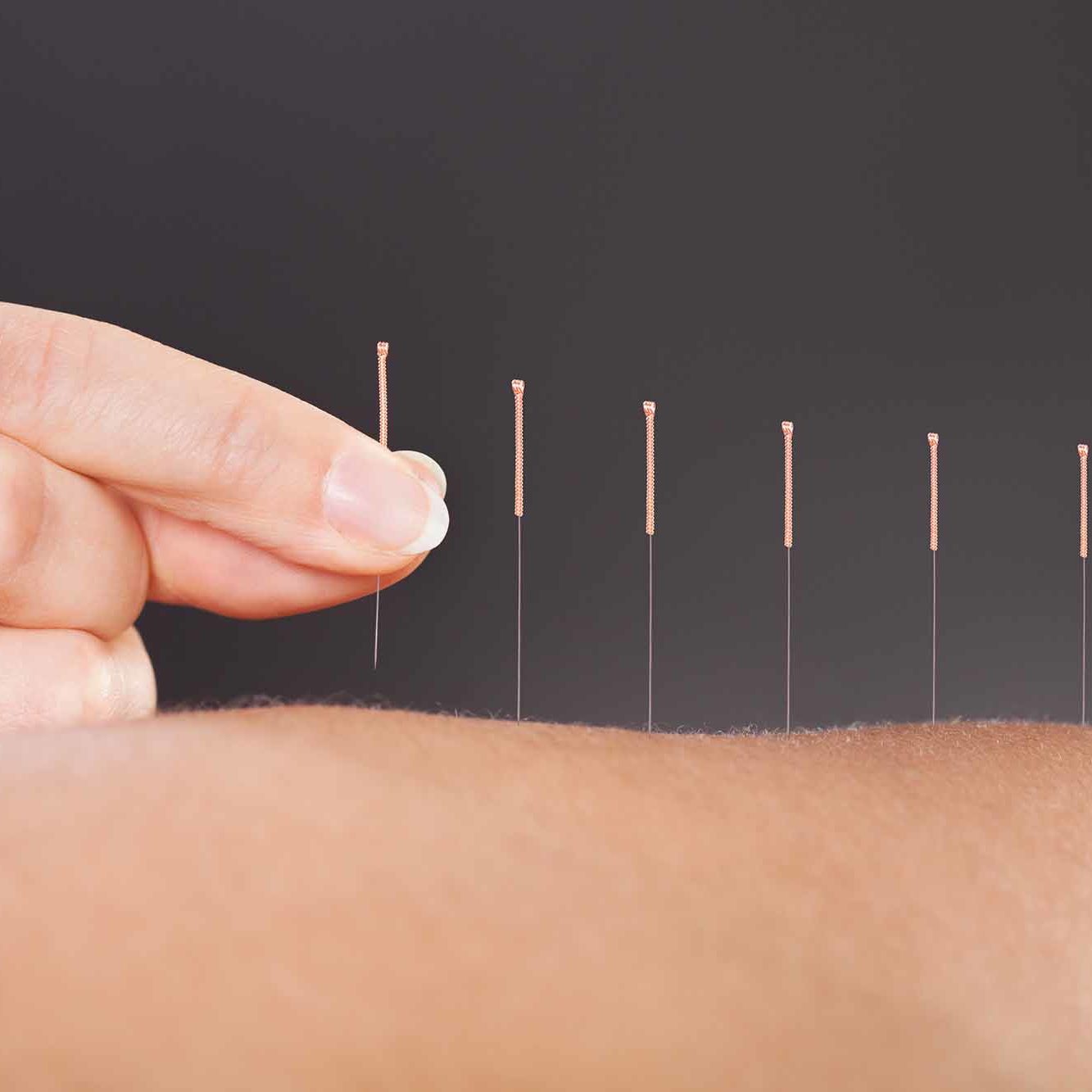 Close-up Of A Person Getting An Acupuncture Treatment At Spa