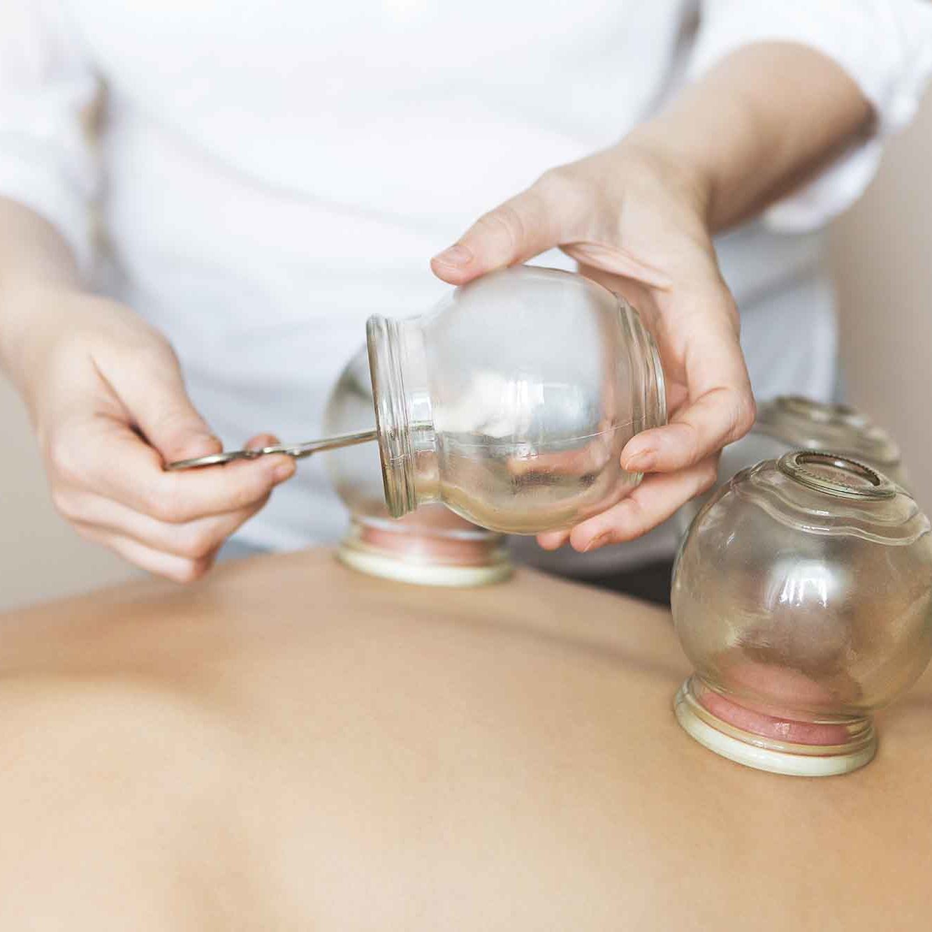 Young woman getting treatment at medical clinic. Fire cupping cups on back of female patient in Acupuncture therapy