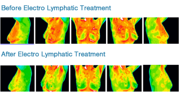 Results From Electro-Lymphatic Therapy (ELT) | Oriental Remedies