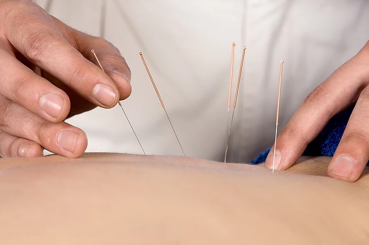 Is Acupuncture Painful? | Oriental Remedies