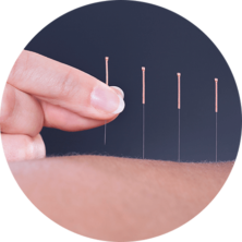  Acupuncture | Oriental Remedies