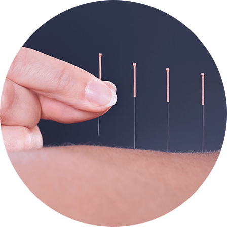 Acupuncture Near Me | Oriental Remedies