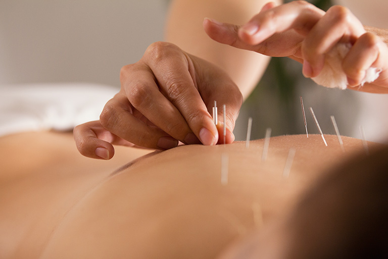 Improve Your IVF Success Rate With Acupuncture | Oriental Remedies