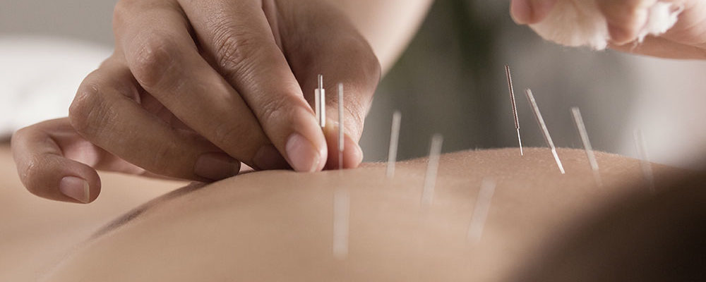 what is acupuncture and how does acupuncture work