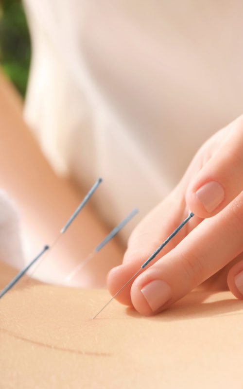 acupuncture Singapore Oriental Remedies