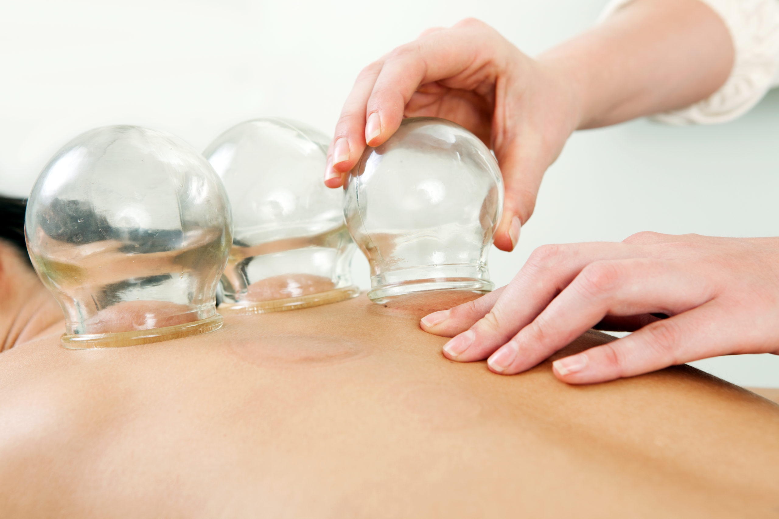 what is cupping and how does cupping works