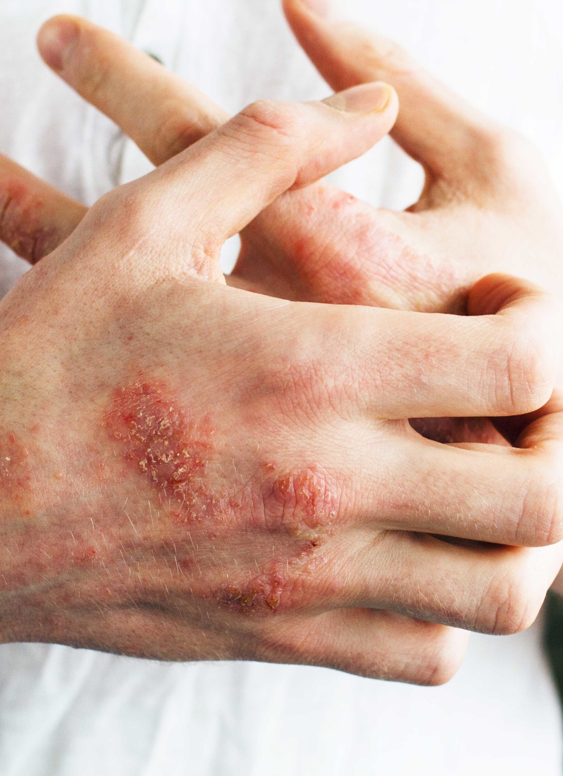 TCM eczema and topical steroid withdrawal (red skin syndrome)