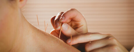 6 Common Myths About Acupuncture Debunked