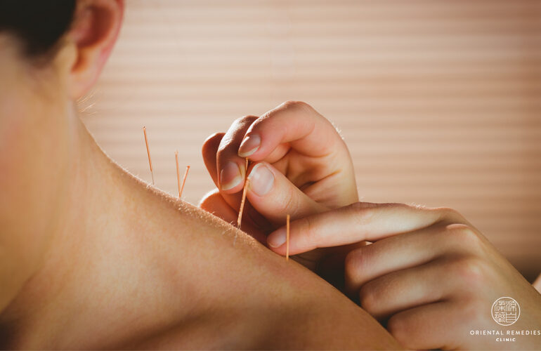 6 Common Myths About Acupuncture Debunked