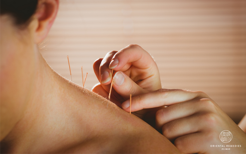 6 Common Myths About Acupuncture Debunked