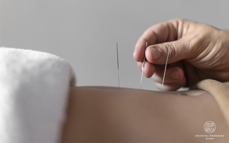  Get acupuncture done in Singapore at Oriental Remedies Group-TCM Physicians singapore