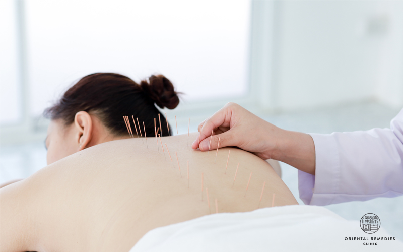 One session of acupuncture is sufficient-acupuncture singapore