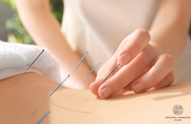 Consider acupuncture-Fertility treatment singapore