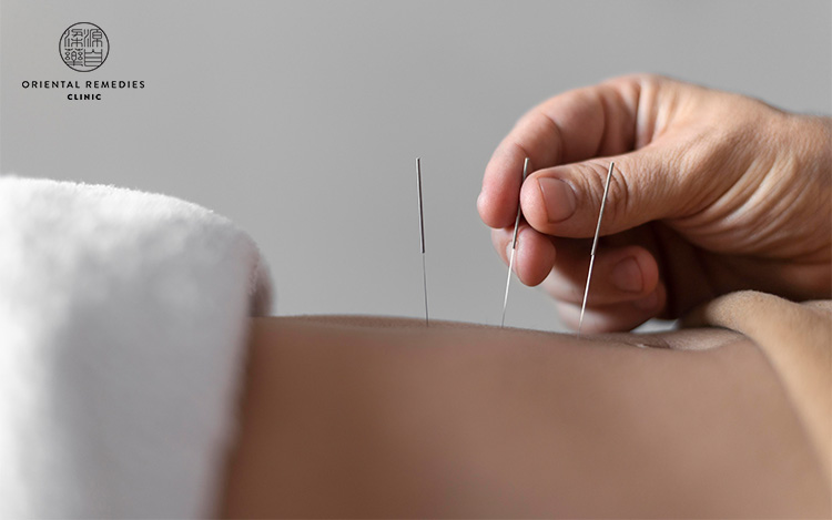 Acupuncture Therapy