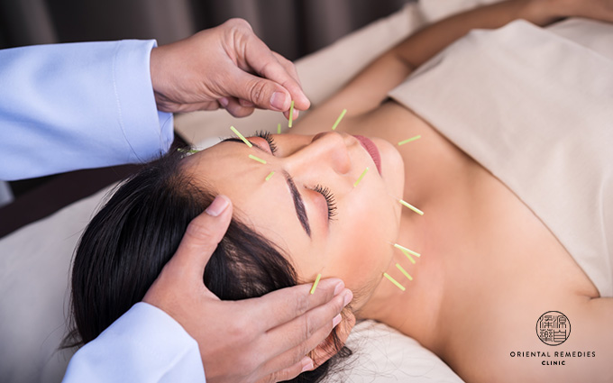 Facial Acupuncture-Tcm Clinic Singapore