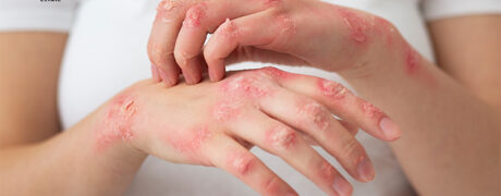 mage of a person suffering from eczema on hand