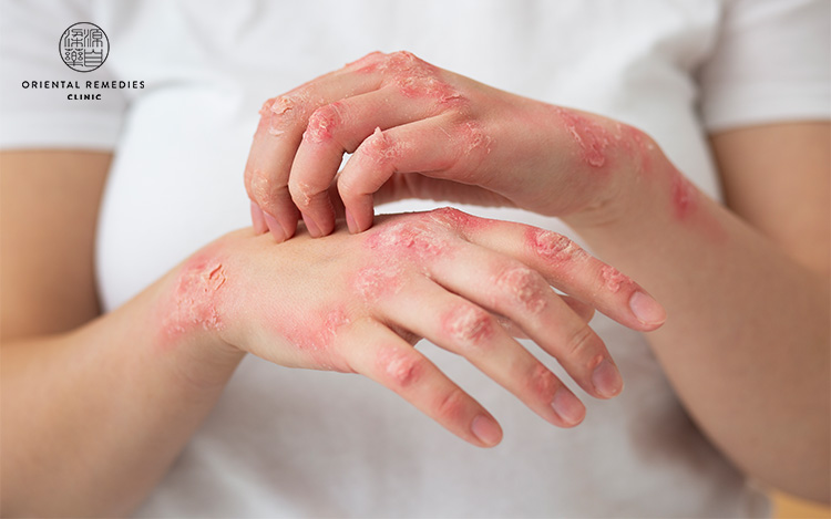 mage of a person suffering from eczema on hand