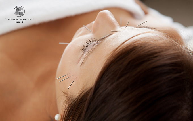 Facial acupuncture treatment for clean and clear skin