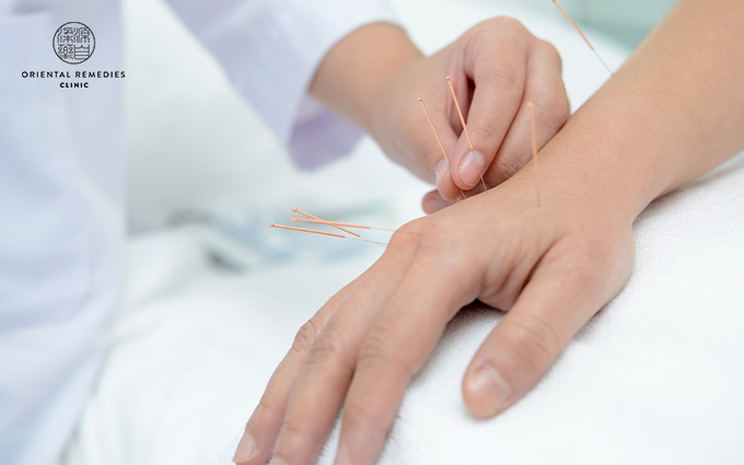 Hand TCM Acupuncture