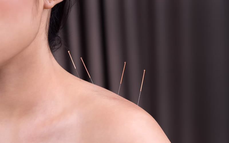 Acupuncture treatment for neck and shoulder pain relief